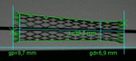 Stents
